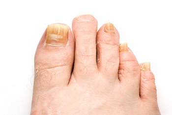 laser treatment